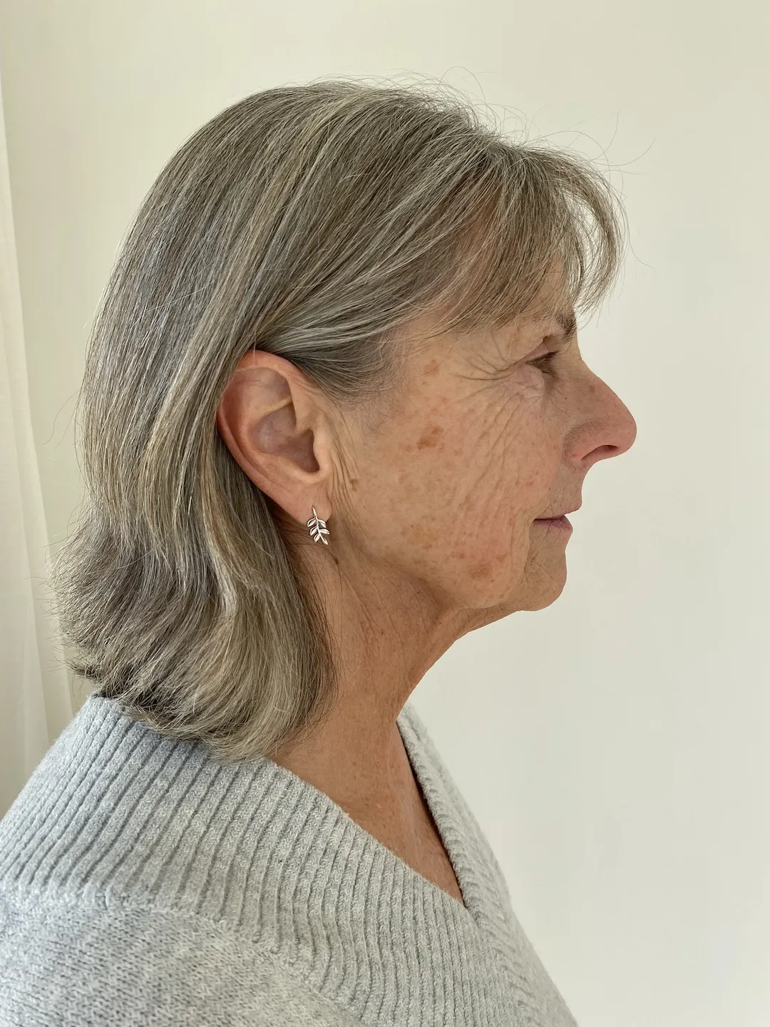 Before a Zone Face Lift